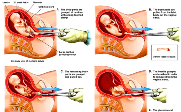 "Those aborted wouldn't be there to vote one day. But we will!" - Webmaster  